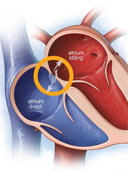 Foramen ovale patent - Cauze, simptome și tratament