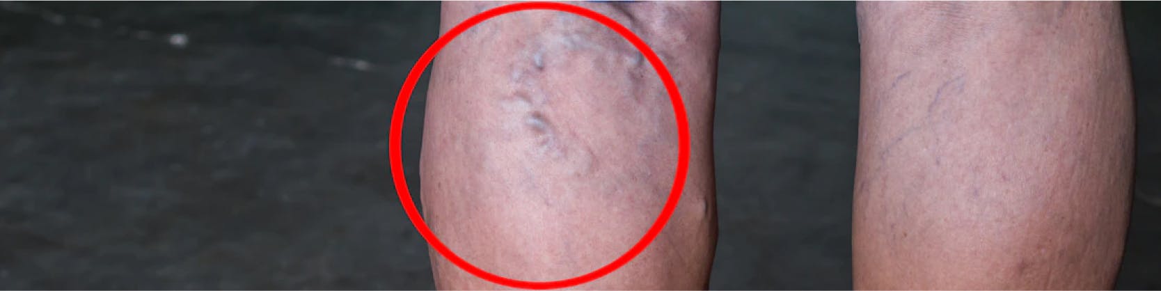 Angioplastie venoasa cu balon si stent | | MONZA ARES