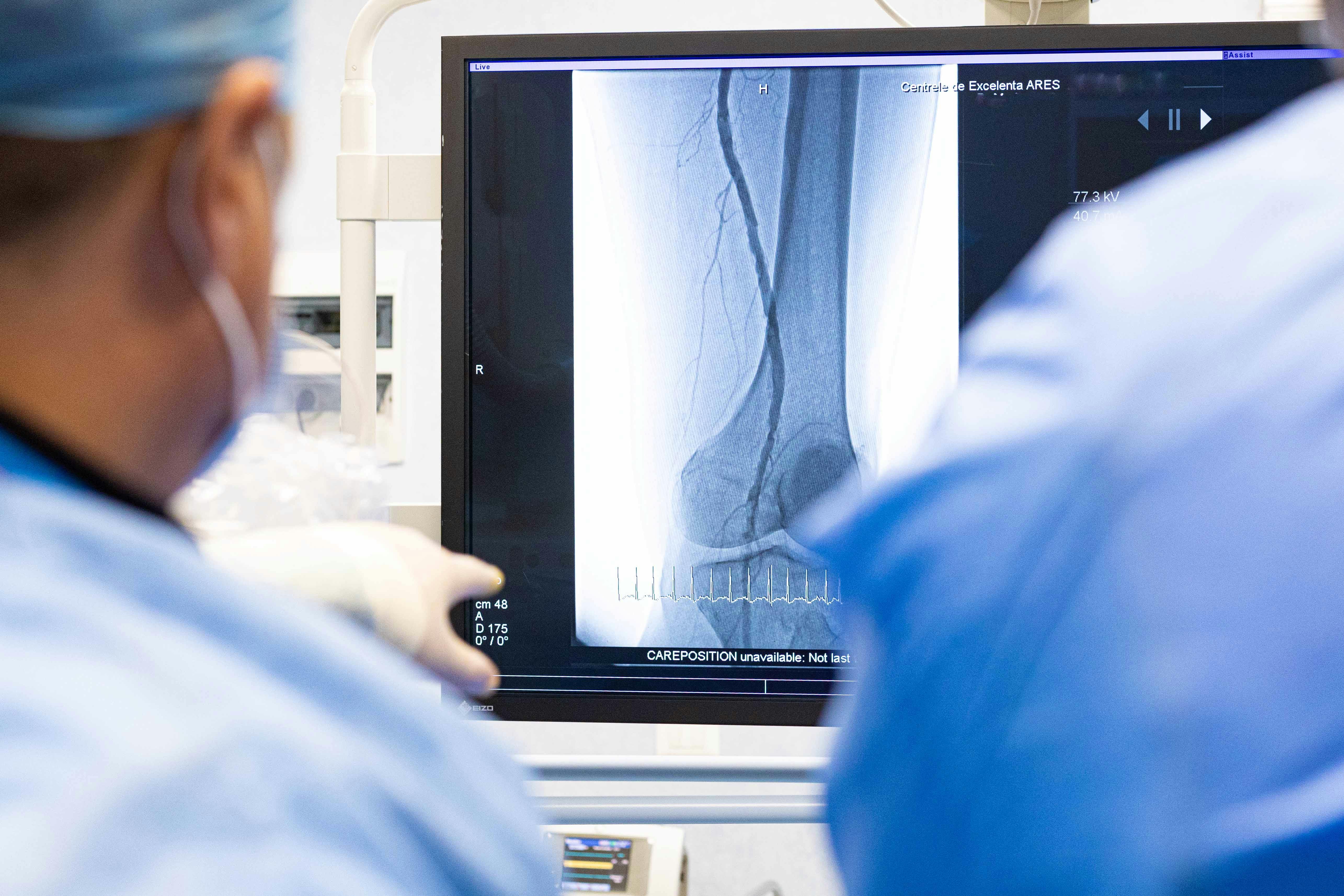 Boala arteriala periferica