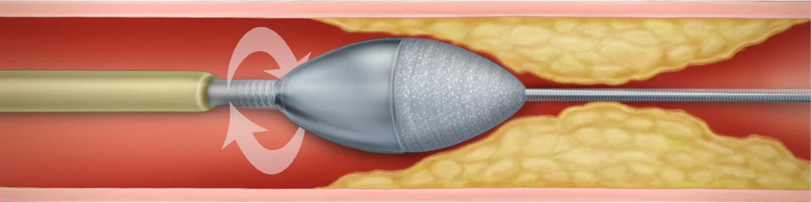 Rotablație coronariană - Tratament angină pectorală (artere calcifiate)