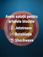 Avem soluții pentru arterele coronare blocate – Trei metode de dezobstrucție arterială la ARES