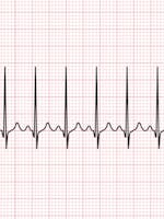 Aritmia cardiaca | Ce trebuie sa stii despre aritmia cardiaca?
