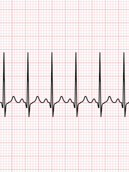 Aritmia cardiaca | Ce trebuie sa stii despre aritmia cardiaca?