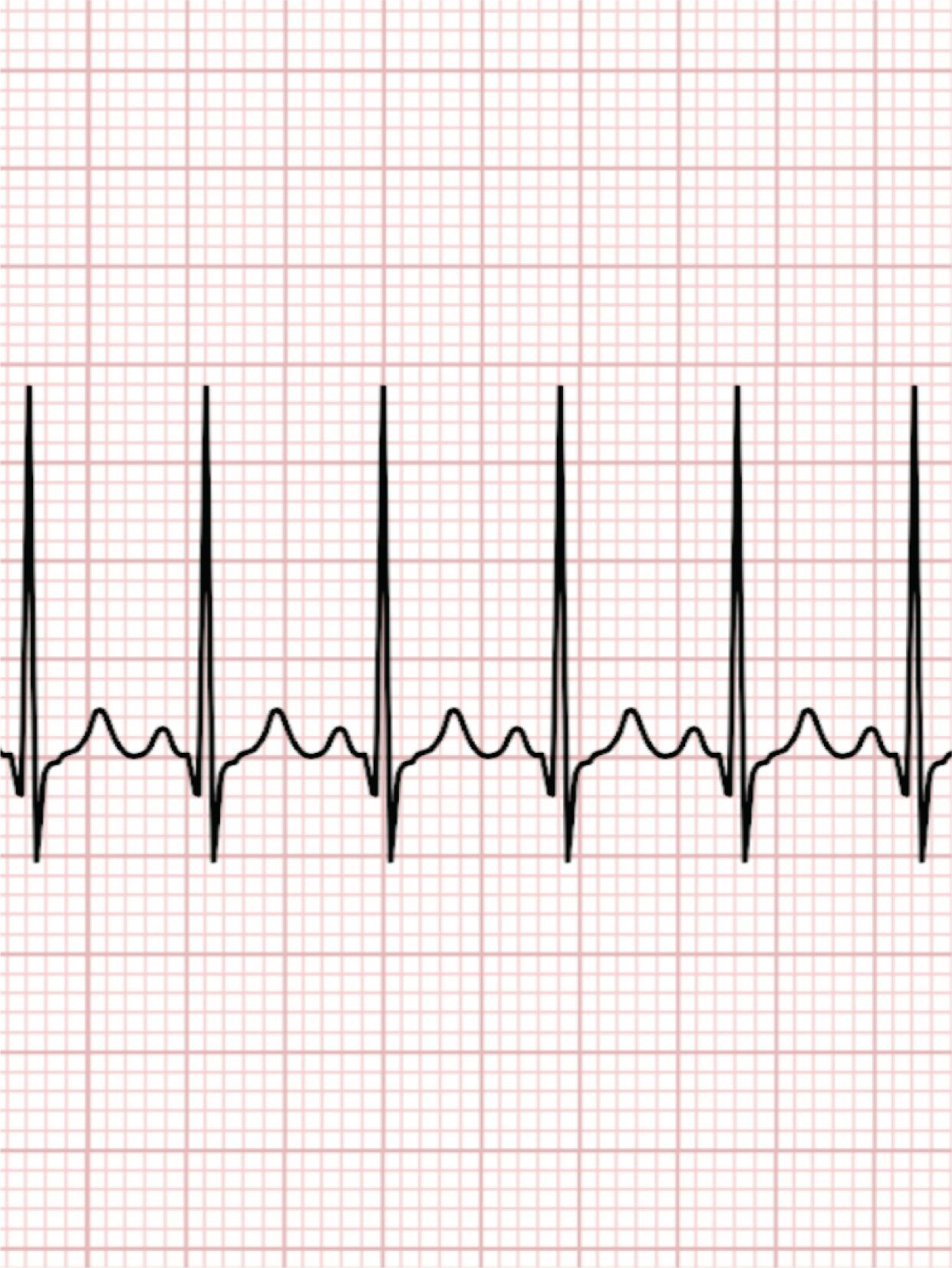 Aritmia cardiaca | Ce trebuie sa stii despre aritmia cardiaca?