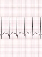 Aritmia cardiaca | Ce trebuie sa stii despre aritmia cardiaca?