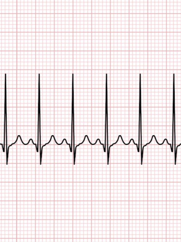 Aritmia cardiaca | Ce trebuie sa stii despre aritmia cardiaca?