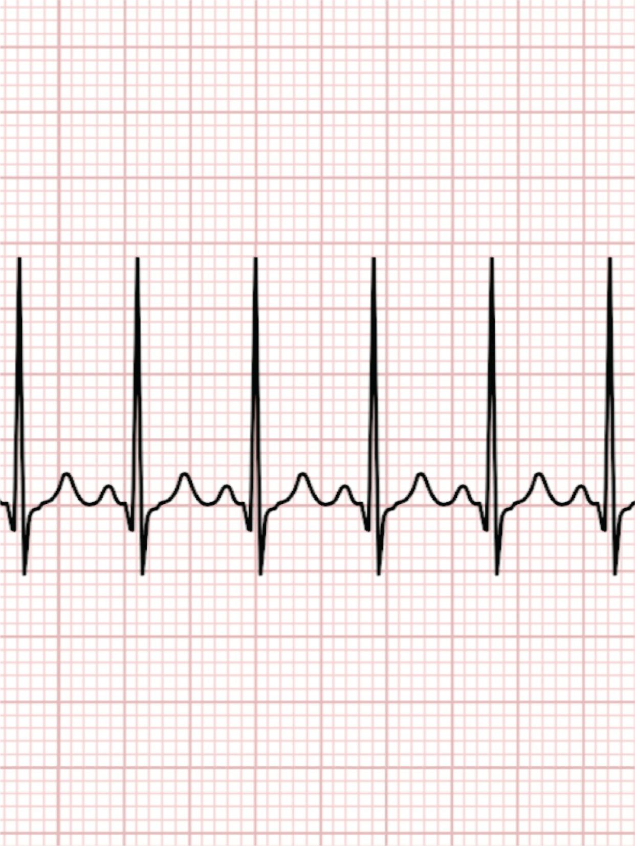 Tot ce trebuie să știi despre pulsul cardiac