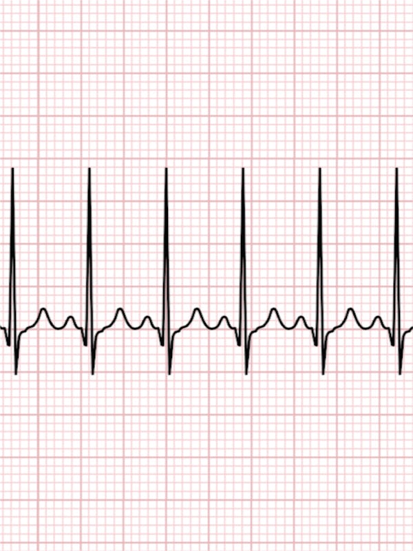 Tot ce trebuie să știi despre pulsul cardiac