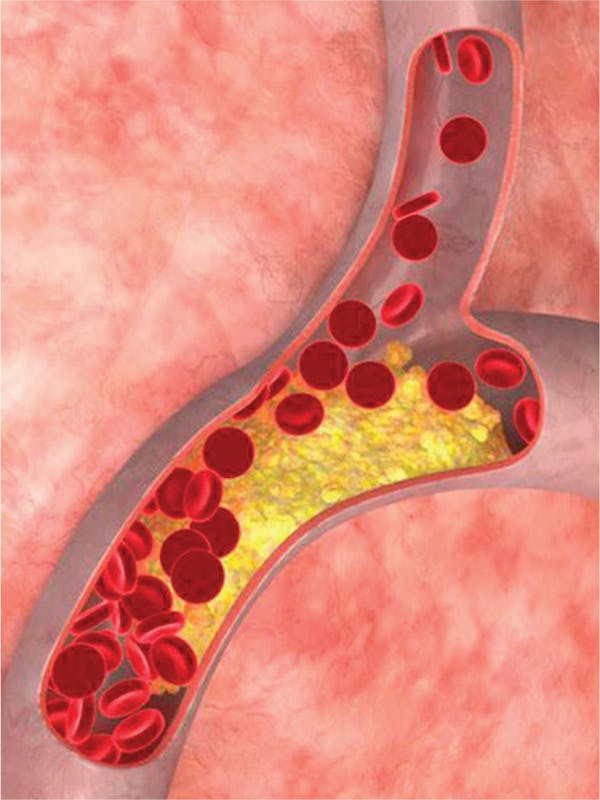 Colesterolul mărit / Hipercolesterolemia – cauze, simptome și tratament