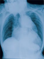 Anevrismul de aorta - Cauze, simptome și tratament