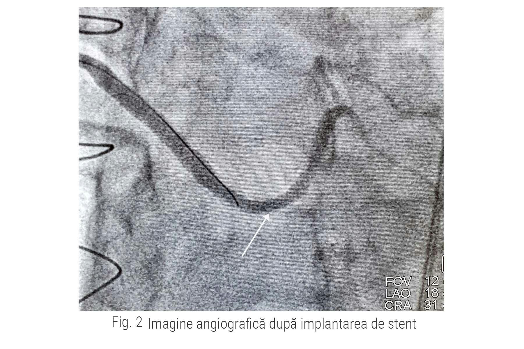 Stent implantat in interiorul unui bypass aorto-coronarian
