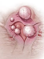 Fibromul uterin - tipuri , cauze, simptome, tratament