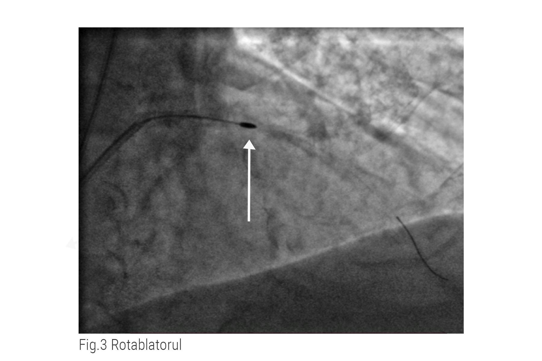 Cateter de rotablatie