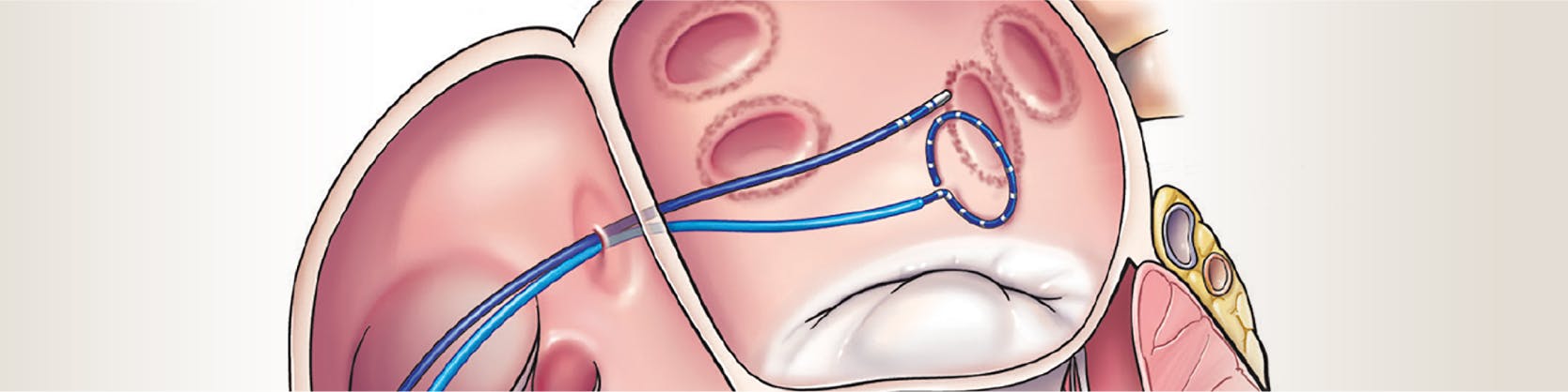 Ablatie pentru flutter atrial | MONZA ARES | Inovatie in Cardiologie