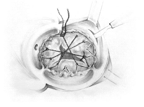 Fig. 1 Desen grafic - Tehnica de explantare conform JCard Surg.2020;1-3