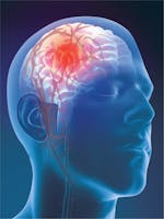 Anevrismul cerebral - cauze, simptome, tratament