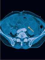 Ischemia mezenterică - Cauze, simptome și tratament