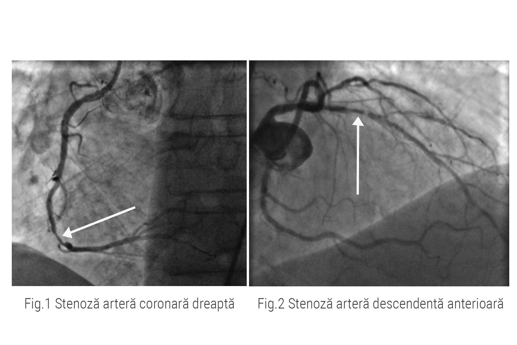 Imagini stenoze coronariene