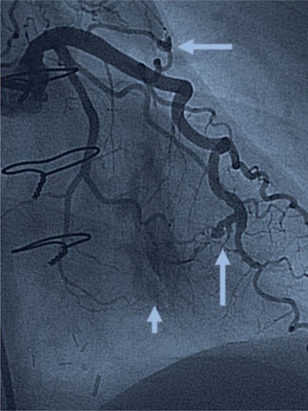 Fistula arterio-venoasă coronariană - cauze, simptome, tratament