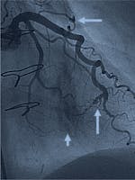Fistula arterio-venoasă coronariană - cauze, simptome, tratament