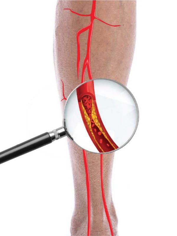 Boala arterială periferică - Cauze, simptome și tratament