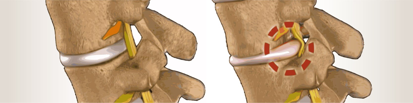 Hernia de disc cervicala | Centrele Ares | Radiologie Interventionala