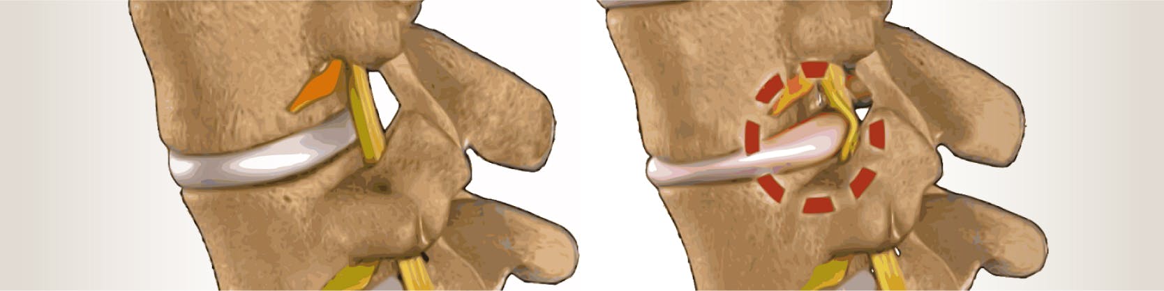 Operatie hernie de disc - Discectomie cervicala | MONZA ARES