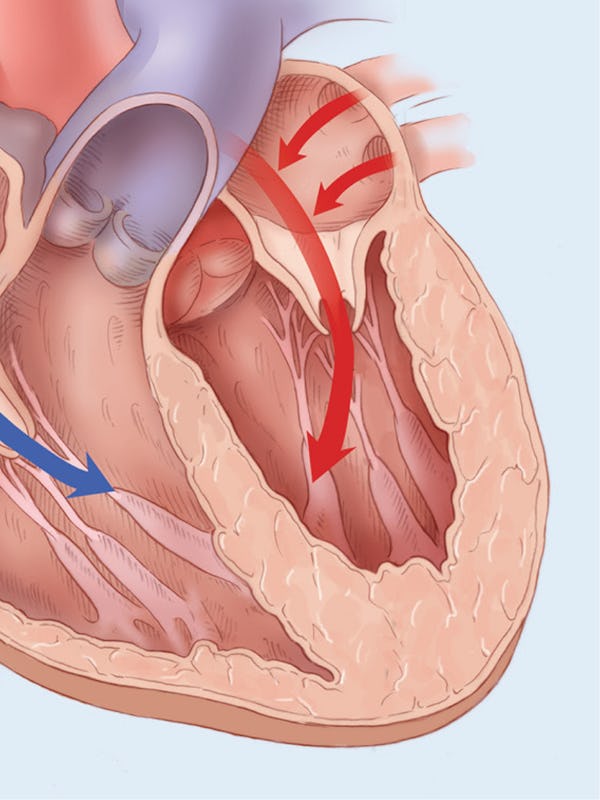 Cardiomiopatie hipertrofică - cauze, simptome și tratament