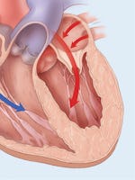 Cardiomiopatie hipertrofică - cauze, simptome și tratament