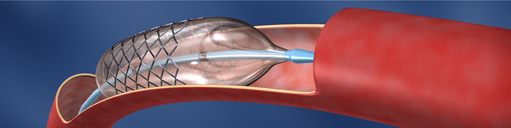 Angioplastie coronariana cu implant de stenturi | ARES