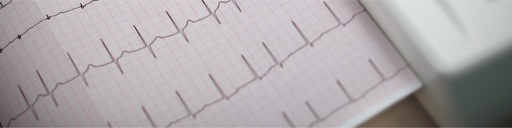 Electrocardiograma - ECG / EKG 