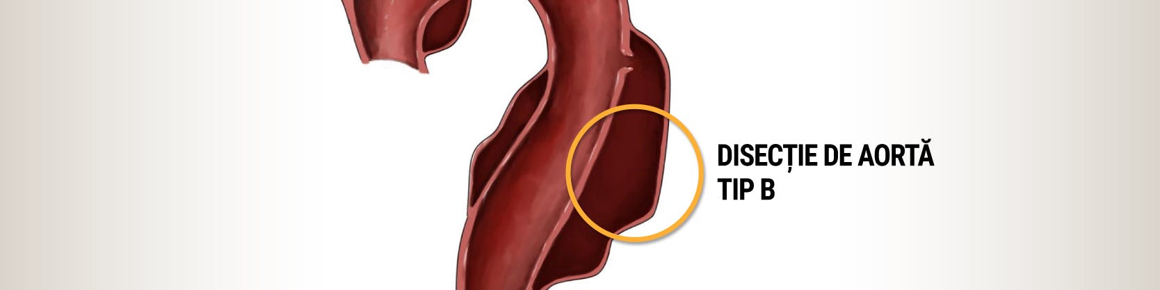 Implantare de stent graft - Disecție de aortă de tip B | Tratament minim invaziv | MONZA ARES