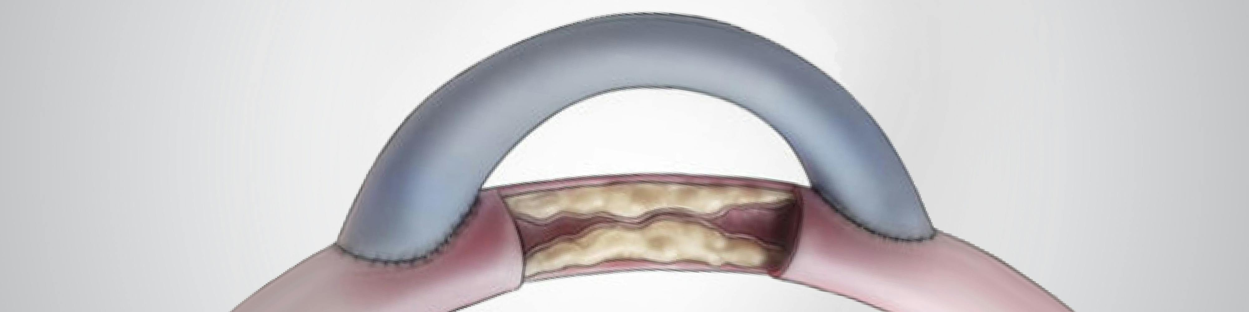 Bypass aorto-femural și femuro-popliteal | MONZA ARES