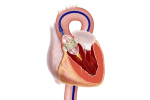 TAVI: Intervenţii gratuite şi la privat - Centrele ARES | Lider in Cardiologie