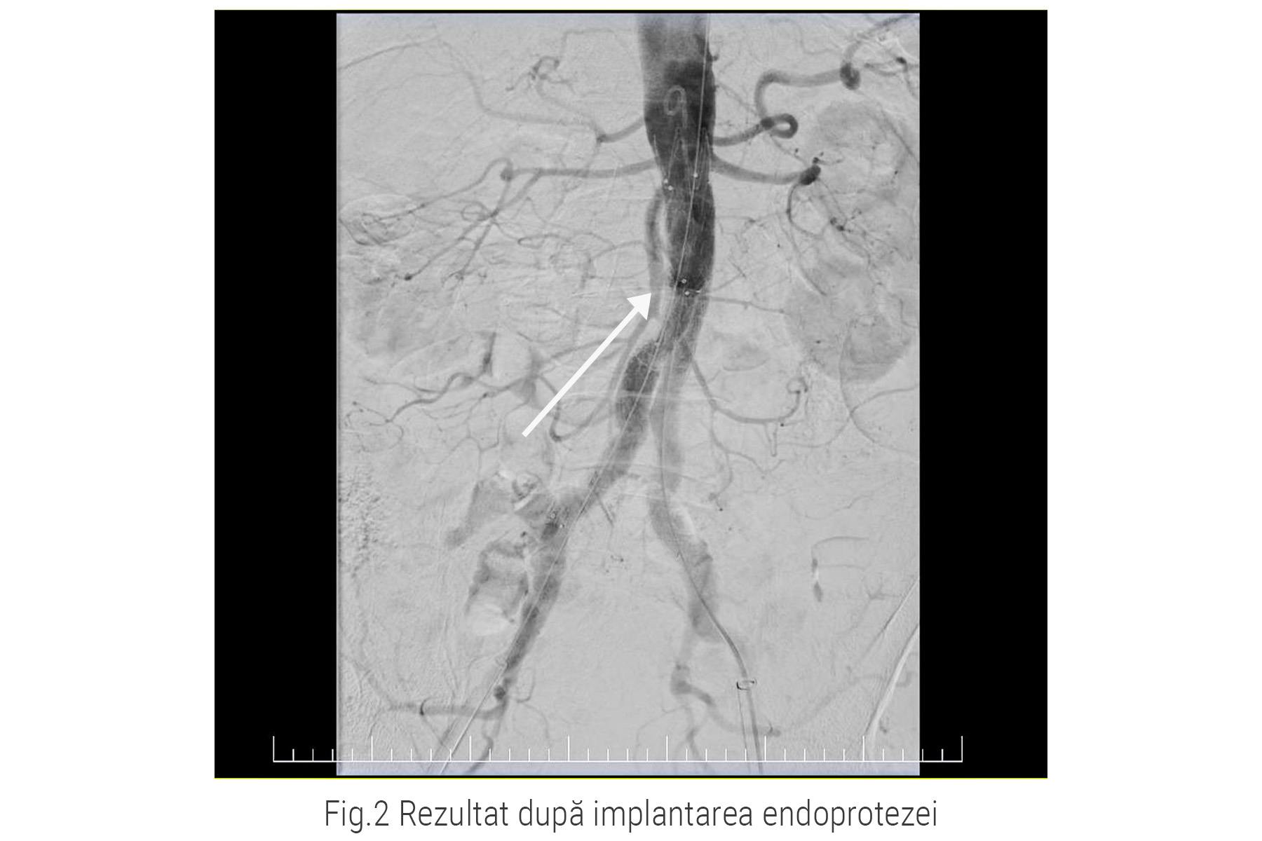 Rezultat implantare endoproteza aortica | Centrele ARES