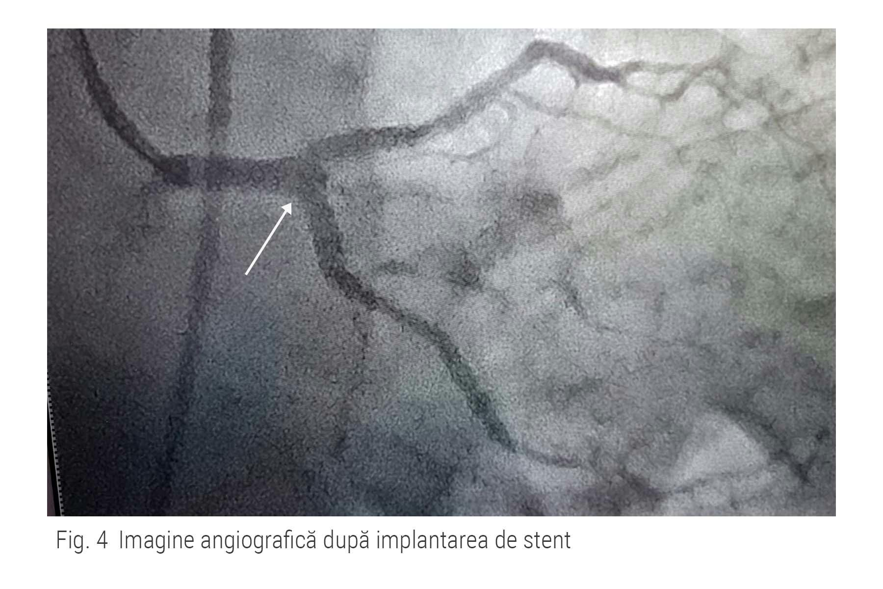 Implantarea de sten pe trunchi comun