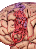 Malformații arterio-venoase cerebrale - cauze, simptome, tratament