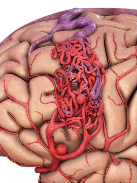 Malformații arterio-venoase cerebrale - cauze, simptome, tratament