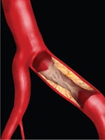 Insuficiența cardiacă - cauze, simptome, tratament