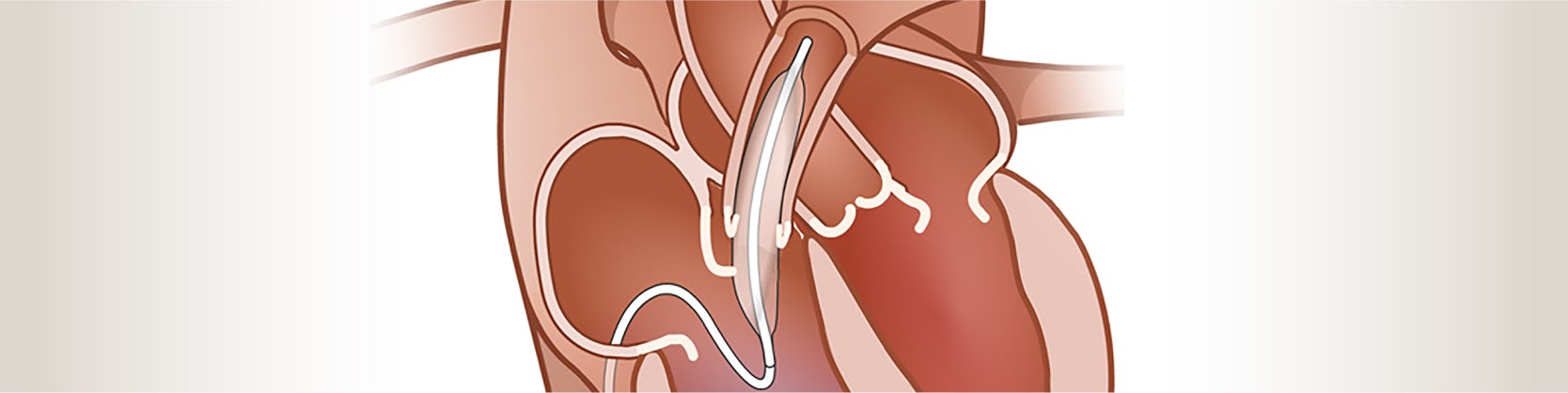 Valvuloplastia pulmonara cu balon | MONZA ARES | Angiologie pediatrica