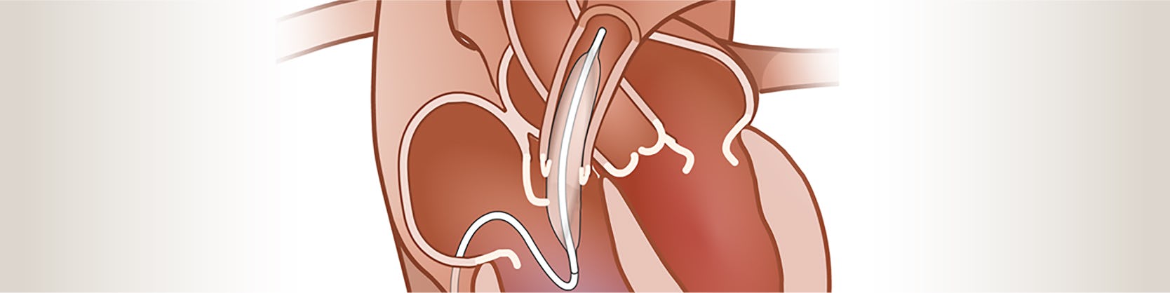 Valvuloplastie pulmonara cu balon / Tratament ingustare valva pulmonara