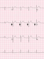 Sindromul WPW (wolf-parkinson-white) - cauze, simptome și tratament