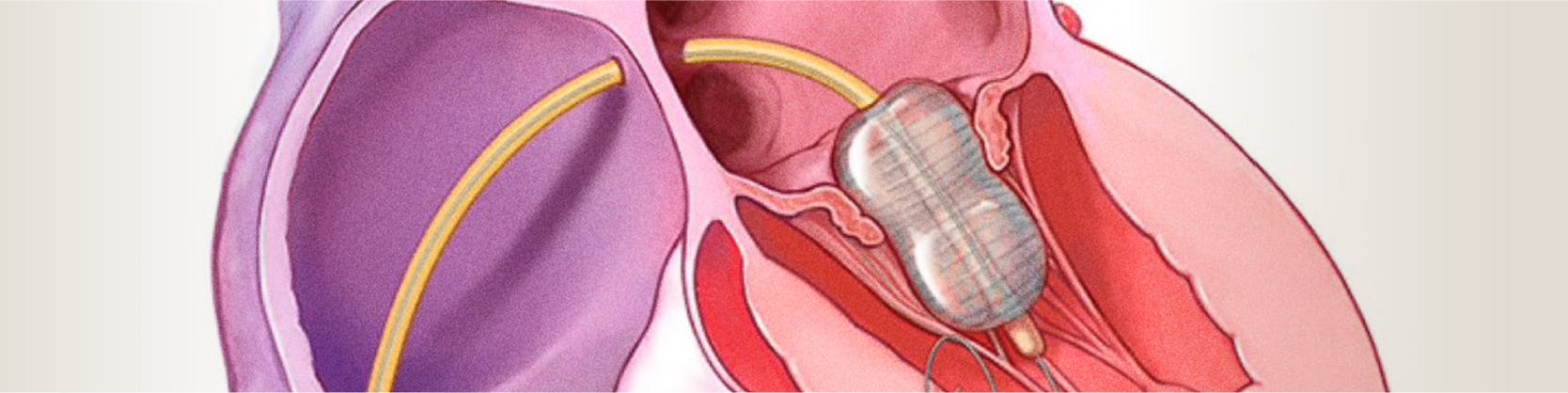 Valvuloplastia mitrala cu balon | MONZA ARES | Inovatie in Cardiologie