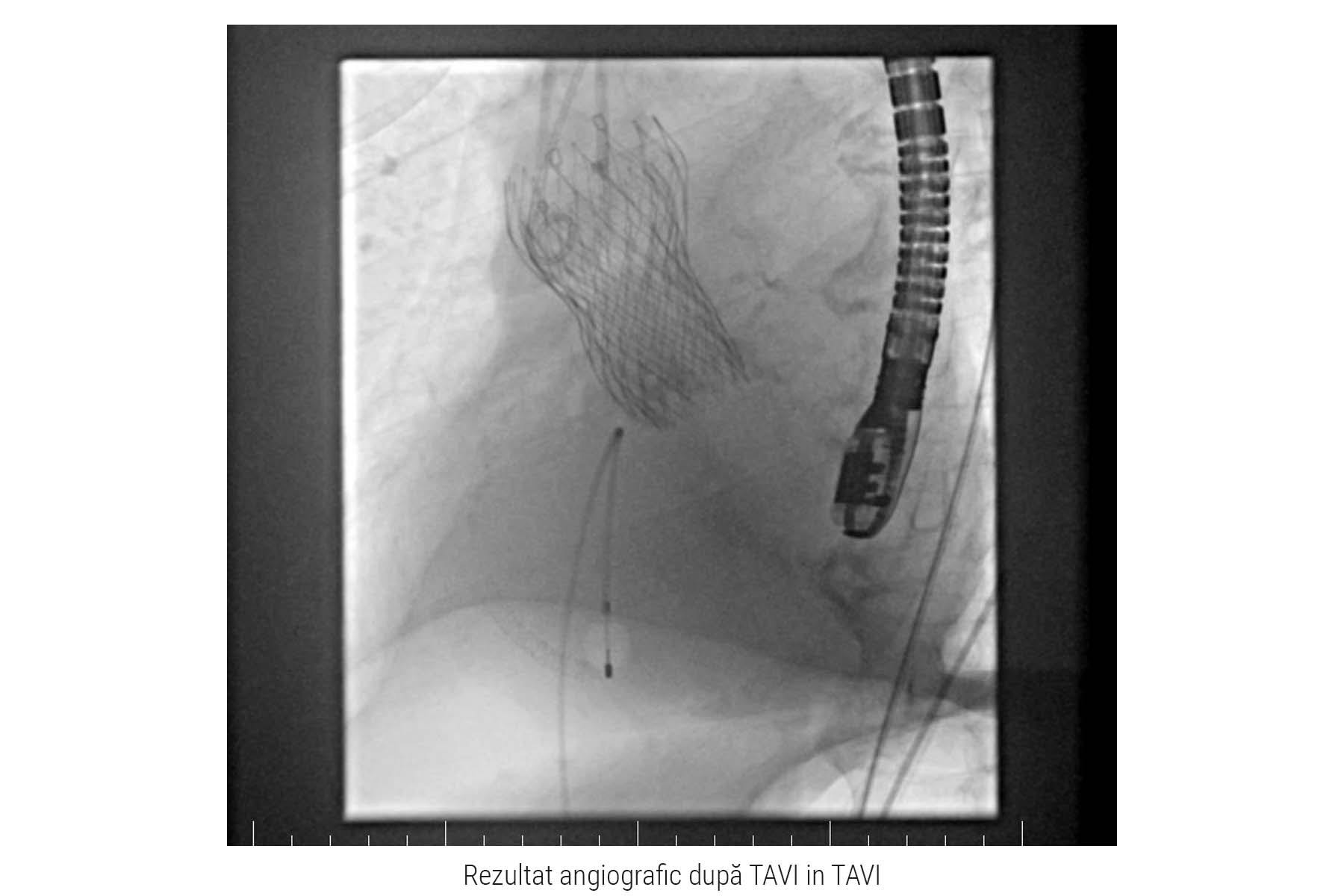 Rezultat angiografic TAVI in TAVI