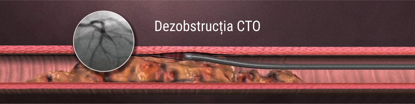 Revascularizarea ocluziilor coronariene cronice totale (CTO) | MONZA ARES