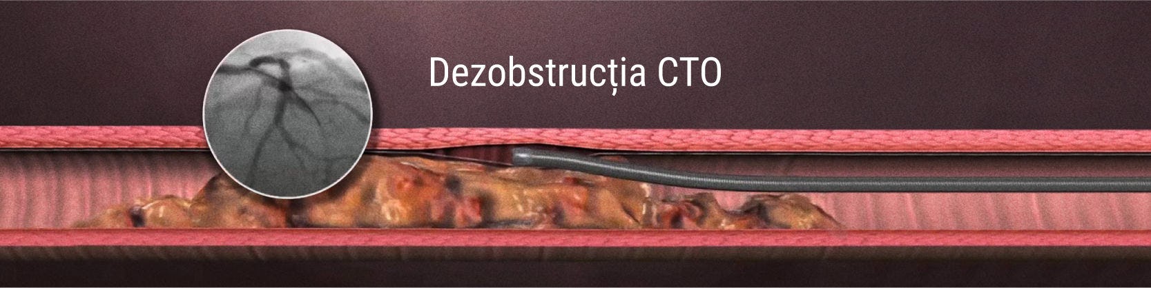 Revascularizarea ocluziilor coronariene cronice totale (CTO)