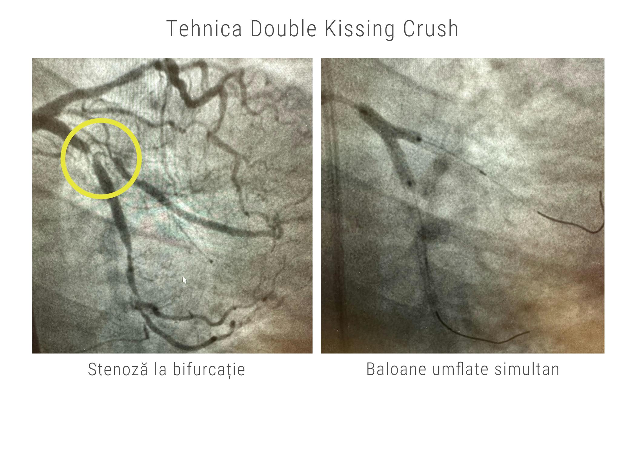 Tehnica intervențională Double Kissing Crush