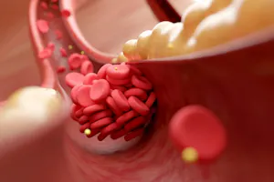 Dislipidemia: Cauze, simptome și tratament