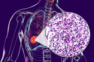 Biopsia pulmonară: ce este, tipuri și riscuri
