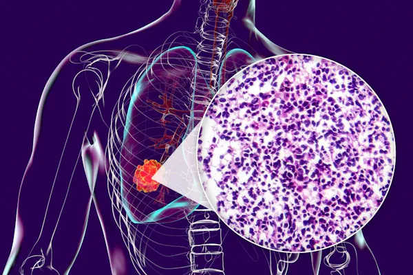 Ilustrație a procedurii de biopsie pulmonară